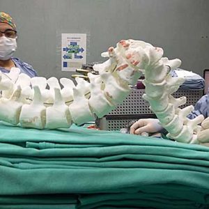 Bioningeniería Desarrolló Un Biomodelo 3D Para Una Cirugía En El Hospital El Cruce